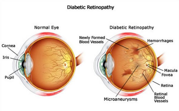 retinopatia-diabetica-natural